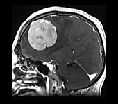 MRI Large Frontal Meningioma