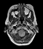 MRI Chiari I Malformation