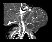 CT of Congenital Teratoma