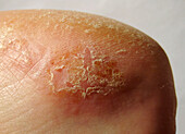 Allergic Contact Dermatitis on Foot