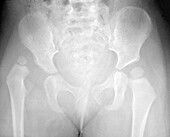 Hip Dysplasia in Child, X-Ray
