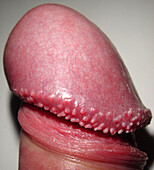 Penis with Hirsutoid Papillomas