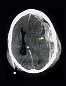 Brain, Subdural Haemorrhage, CT Scan
