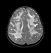 Vanishing White Matter Disease