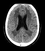 White Matter Disease Secondary to Chemotherapy