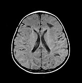 Vanishing White Matter Disease