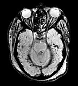 Traumatic Brain Injury MRI