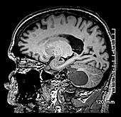 Cerebellar Hemangioblastoma MRI