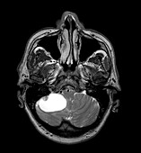 Cerebellar Hemangioblastoma MRI