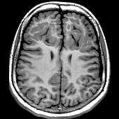 Malformation of Cortical Development MRI