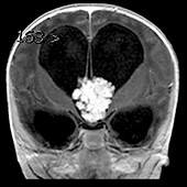 MRI Choroid Plexus Papilloma in Infant