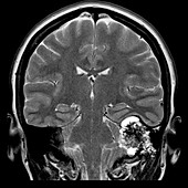 MRI Endolymphatic Tumour