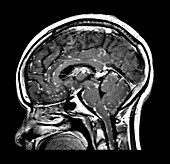 Neuro Sarcoid on MRI