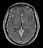 Neuro Sarcoid on MRI