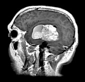 Atypical Meningioma on MRI
