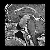 MRI Pituitary Macroadenoma