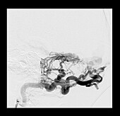Dural Arteriovenous Malformation on Angiography