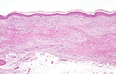 Necrobiosis lipoidica, LM