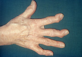 Osteoarthritis of the Hand