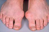 Gout Swelling