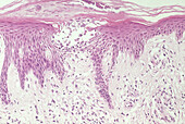 Spongiotic Vesicular Dermatitis, LM