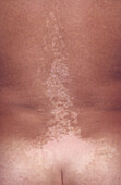 Skin Pigmentation and Myxedema