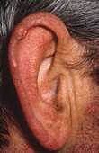 Gout Tophi on Ear Cartilage