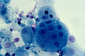 HIV infected macrophages, light micrograph
