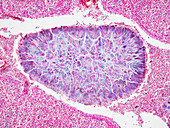 Calcified mass in tonsil, light micrograph