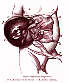 Congenital umbilical hernia, 19th century illustration
