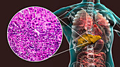 Liver cirrhosis, illustration and light micrograph