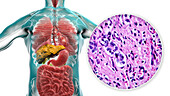 Liver cirrhosis, illustration and light micrograph