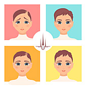 Hair transplantation surgery result in women, illustration