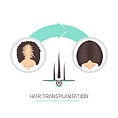 Hair transplantation in women, conceptual illustration