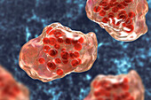 Measles virus infection, illustration