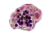 Measles virus infection, illustration