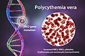 Polycythemia vera, illustration