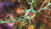 Neurons in Tay-Sachs disease, illustration