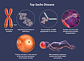 Tay-Sachs disease, illustration