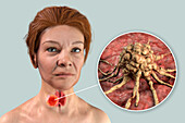 Thyroid gland cancer, illustration