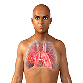 Pulmonary mucormycosis, illustration