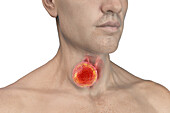 Thyroid gland tumour, illustration