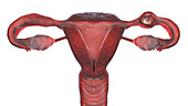 Ectopic pregnancy, illustration