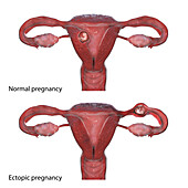 Normal and ectopic pregnancy, illustration