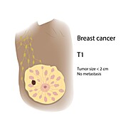 Female breast cancer T1, illustration
