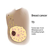 Female breast cancer T3, illustration