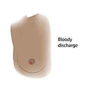Bloody discharge from nipple, illustration