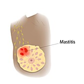 Mastitis in female breast, illustration