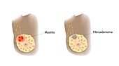 Mastitis and fibroadenoma comparison, illustration