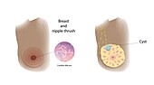 Cyst and thrush comparison, illustration